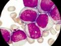 Leucemia